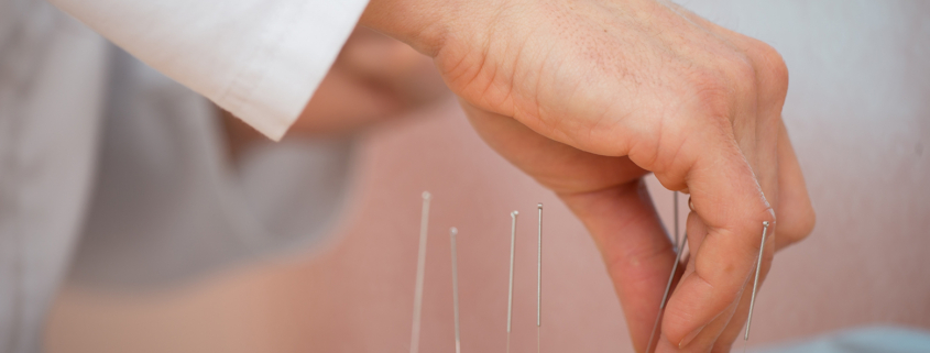 Patient receiving acupuncture treatment.