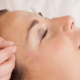 Patient receiving facial acupuncture treatment to reduce puffiness.