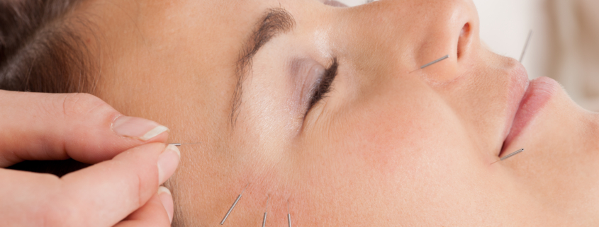 Patient receiving facial acupuncture treatment to reduce puffiness.