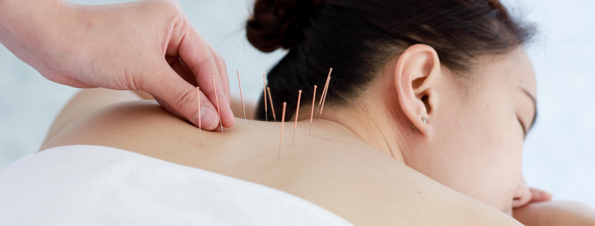 Patient receiving acupuncture for anxiety treatment.