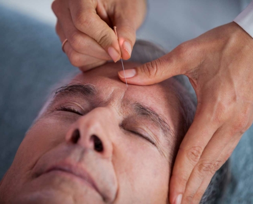 A patient receiving acupuncture treatment for chronic pain.