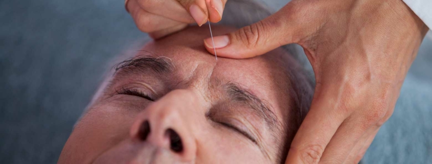 A patient receiving acupuncture treatment for chronic pain.
