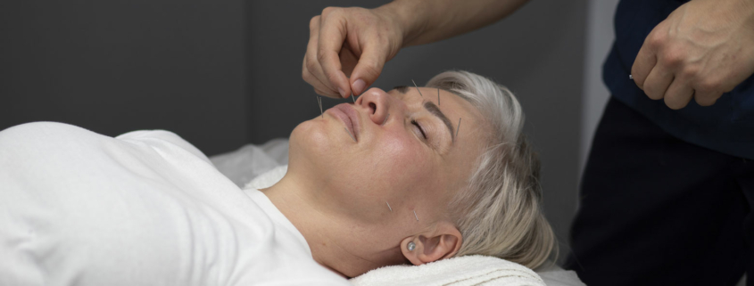 A woman receiving facial acupuncture treatment to reduce sinus pressure.