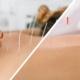 Side-by-side images of a person receiving dry needling vs acupuncture treatments.