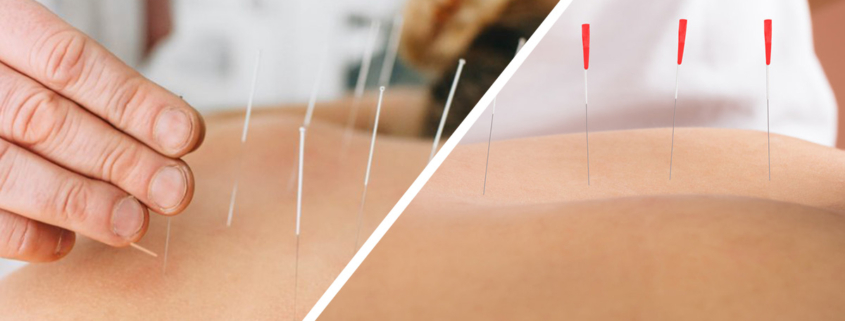 Side-by-side images of a person receiving dry needling vs acupuncture treatments.